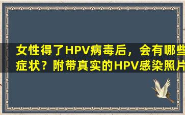 女性得了HPV病毒后，会有哪些症状？附带真实的HPV感染照片