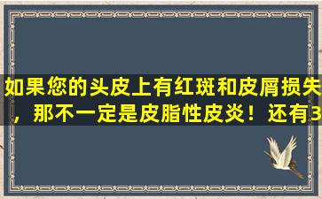如果您的头皮上有红斑和皮屑损失，那不一定是皮脂性皮炎！还有3种头皮疾病