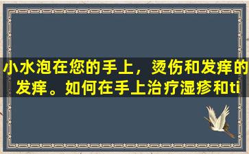 小水泡在您的手上，烫伤和发痒的发痒。如何在手上治疗湿疹和tinea功能障碍？整篇文章将向您解释