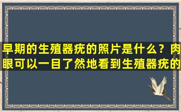 早期的生殖器疣的照片是什么？肉眼可以一目了然地看到生殖器疣的症状吗？