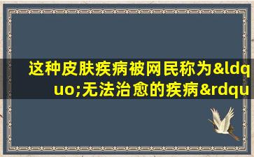 这种皮肤疾病被网民称为“无法治愈的疾病”！西中国皮肤科医生教您如何处理